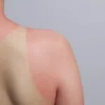 There are a number of very effective sunburn treatments to give you the relief you seek. Keep reading to learn more about sunburn treatments!