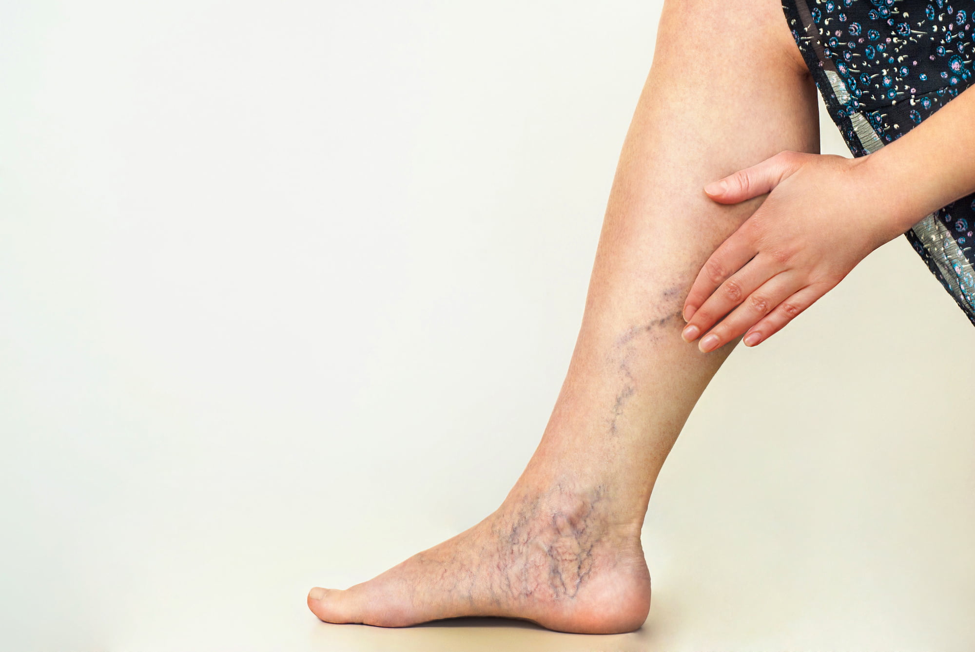 If you're trying to figure out how to get rid of varicose veins, you're in luck! Our guide here explains the different things you can do.