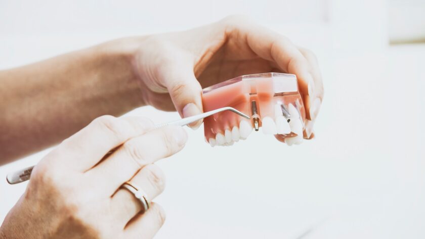 how to choose dental implants