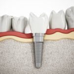 Did you know that not all dental implants are created equal these days? Here are the many different types of dental implants that are used today.