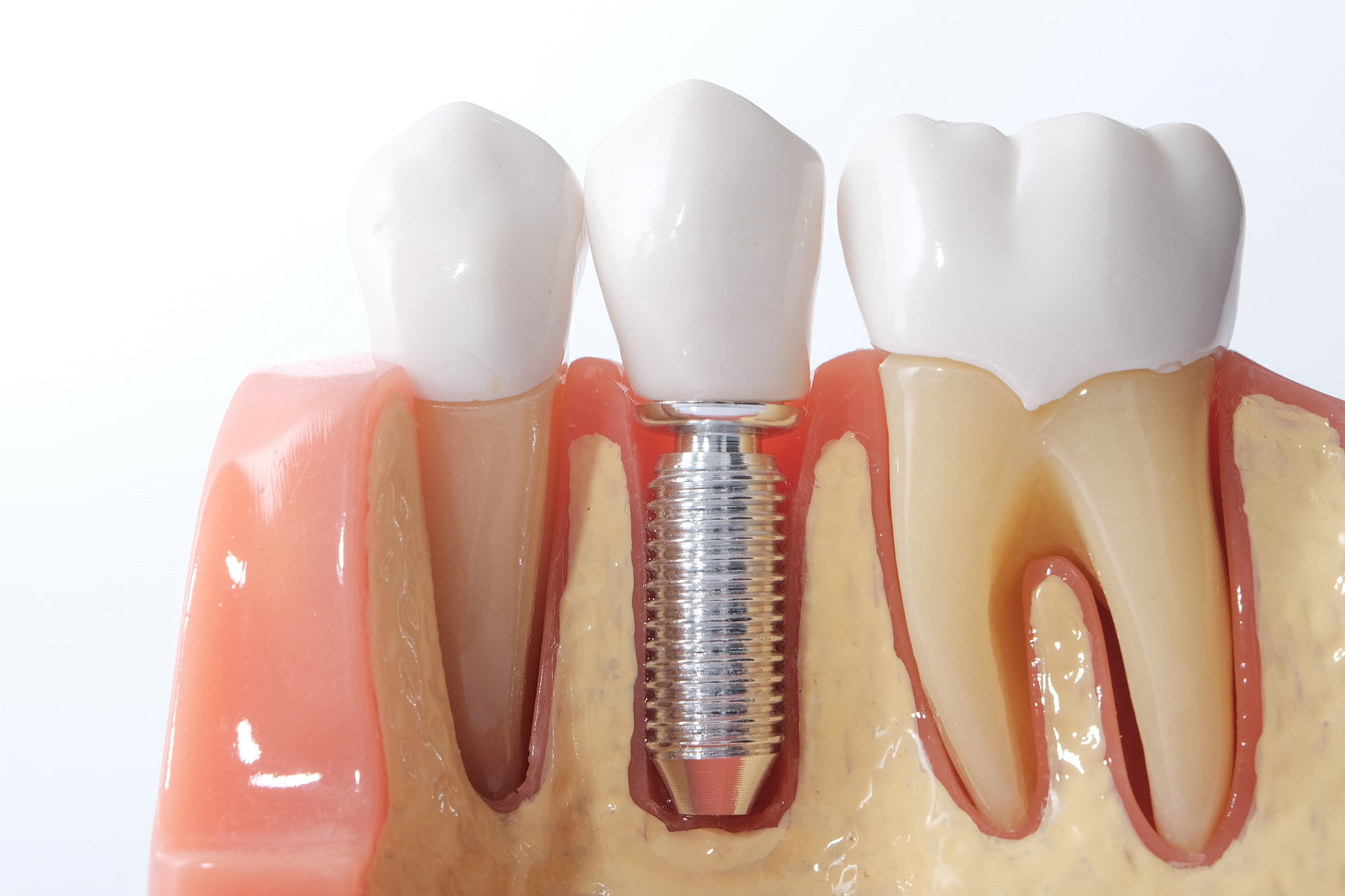 If you have missing teeth, you should consider getting dental implants. This guide breaks down the different benefits of dental implants.
