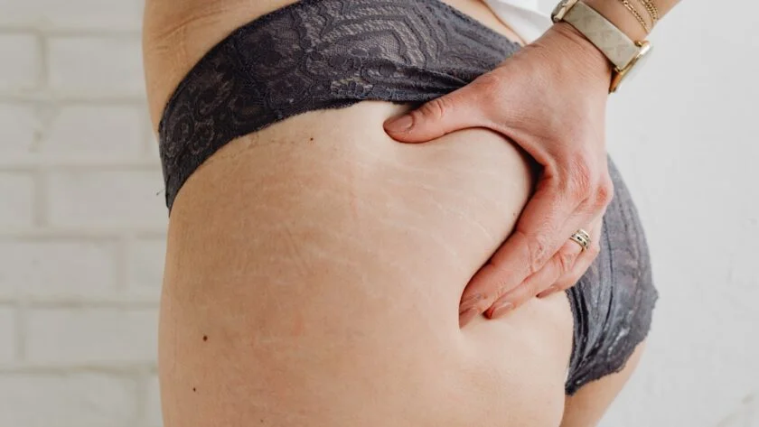 Kratom For Stretch Marks: How It Works