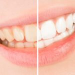 Tooth discoloration can be a problem for many people. If you're concerned about the appearance of your teeth, read more about the causes of stained teeth today.