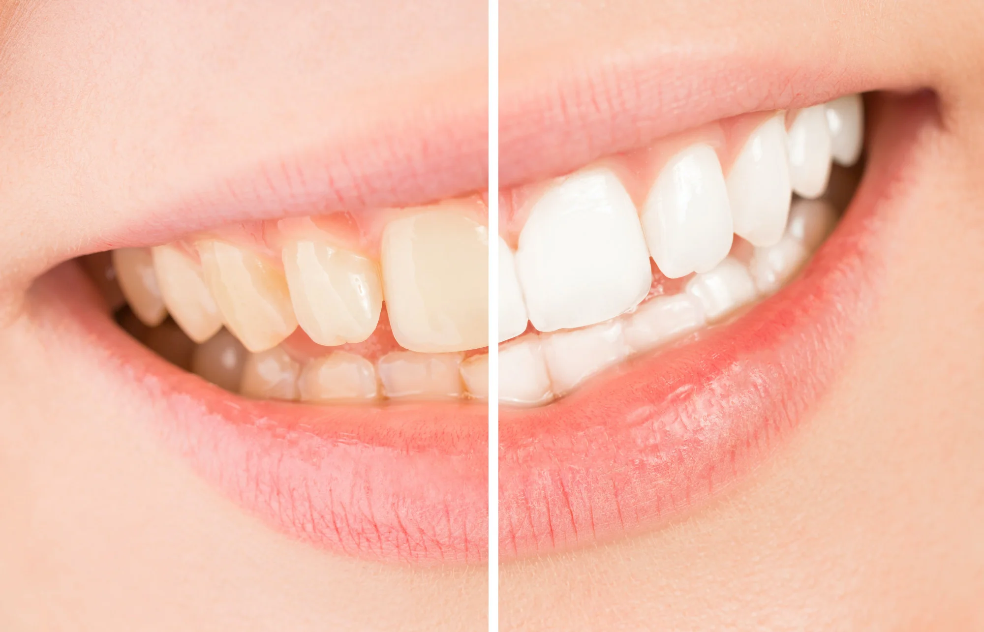 Tooth discoloration can be a problem for many people. If you're concerned about the appearance of your teeth, read more about the causes of stained teeth today.