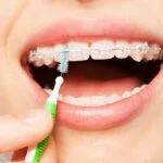 Orthodontic coverage options can help with braces payments and other orthodontic treatments. Learn the best options for 2022 here.