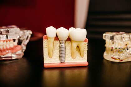 Dental Implants are Gaining Popularity – What are the Benefits That You Need to Know About?