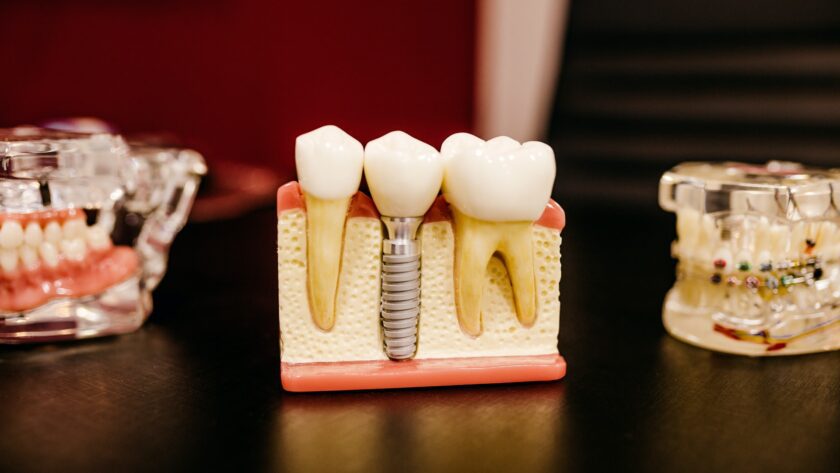 Dental Implants are Gaining Popularity – What are the Benefits That You Need to Know About?