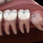 Are you getting ready to have your wisdom teeth removed? Here's everything you can expect from wisdom teeth removal surgery.