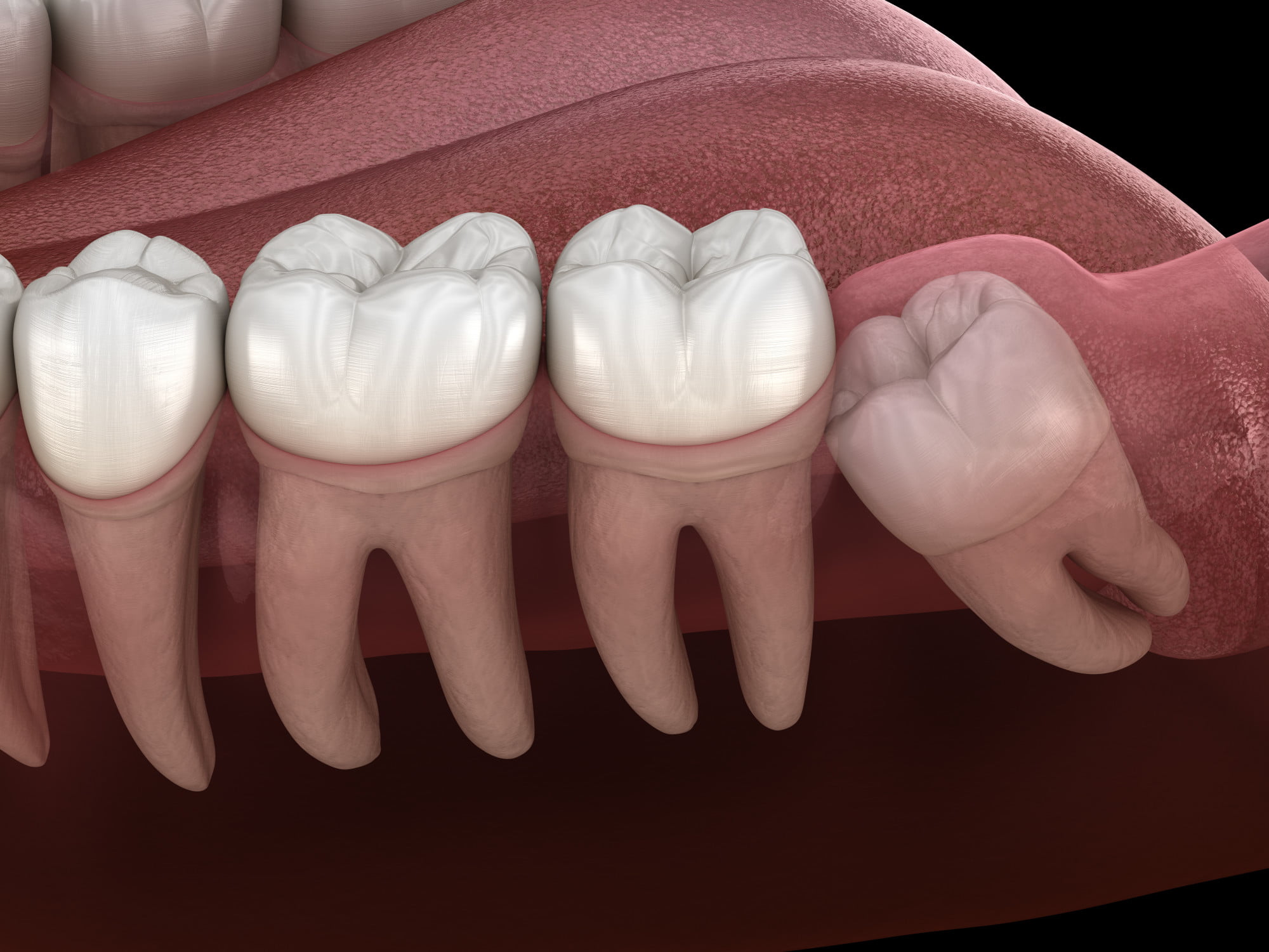 Are you getting ready to have your wisdom teeth removed? Here's everything you can expect from wisdom teeth removal surgery.