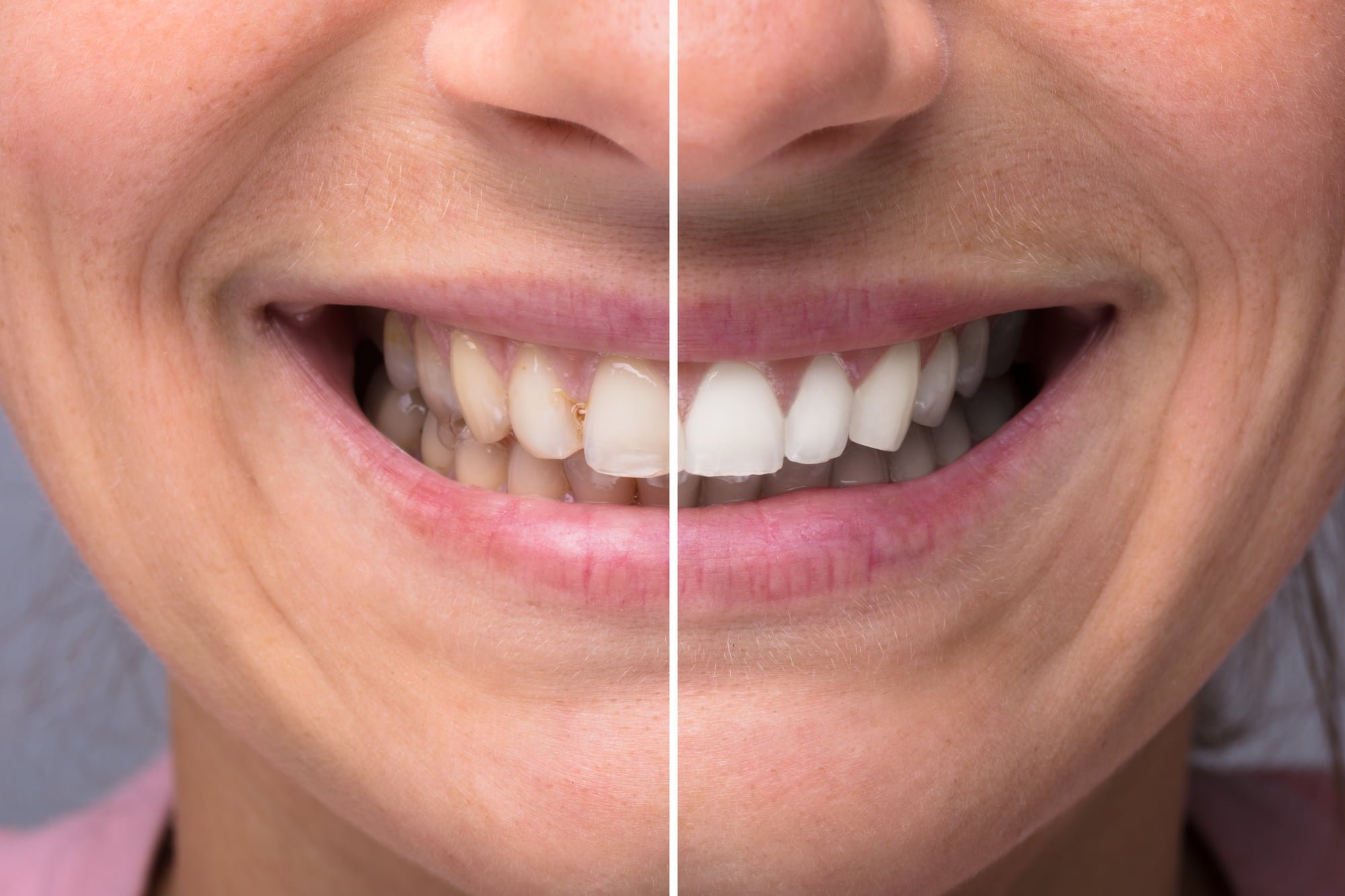 Do you know how stains get on your teeth? Explore your options for any tooth stain with these teeth whitening procedures.