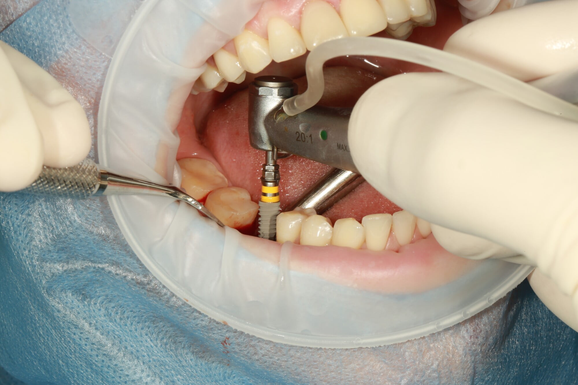 There are several advantages of getting implants if you have missing teeth, but how long do dental implants last? Here's what you need to understand.