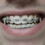 How Braces Can Improve Your Oral Health - A Comprehensive Guide