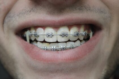How Braces Can Improve Your Oral Health - A Comprehensive Guide