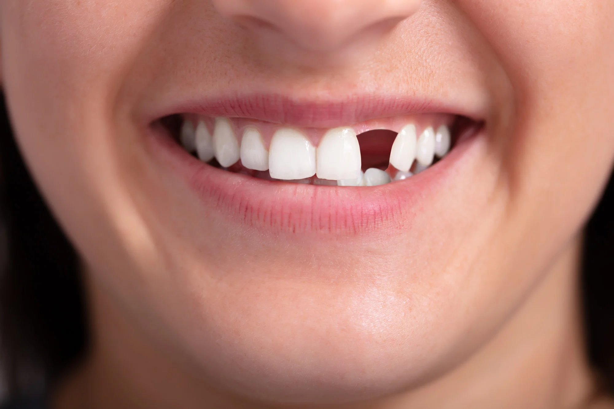 Are you tired of dealing with problems with your dental implants? Click here for three telltale signs that you need a dental implant repair.