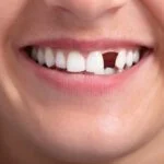 If you have one or more missing teeth, then you may be searching for a solution. Here are a few tooth replacement options for you to consider.