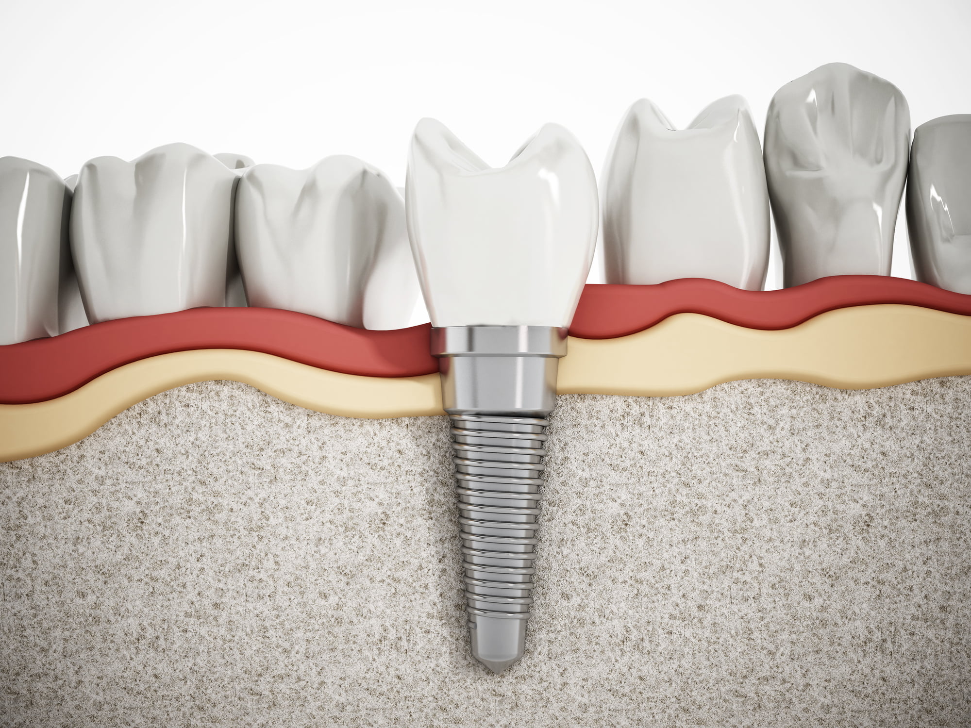 Dental implants might be a great investment for your dental health. Click here for a guide to the average dental implant cost in 2023.