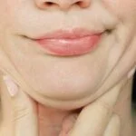 Are you tired of struggling to get rid of your double chin? Click here for a patient's guide to cool sculpting for double chin reduction.
