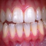 Understanding the Advantages of Connective Tissue Grafts for Periodontal Health