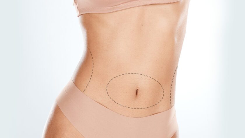 Beyond a Flatter Stomach: Functional Improvements of a Tummy Tuck